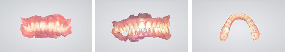 Huge USA's i-Vinci Smart Intra Oral Scanner